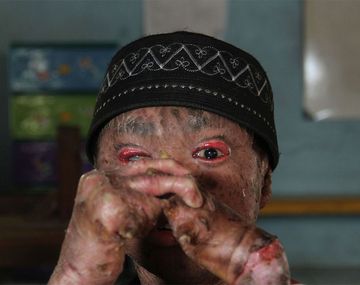 El caso del chico serpiente: cambia de piel cada 40 días