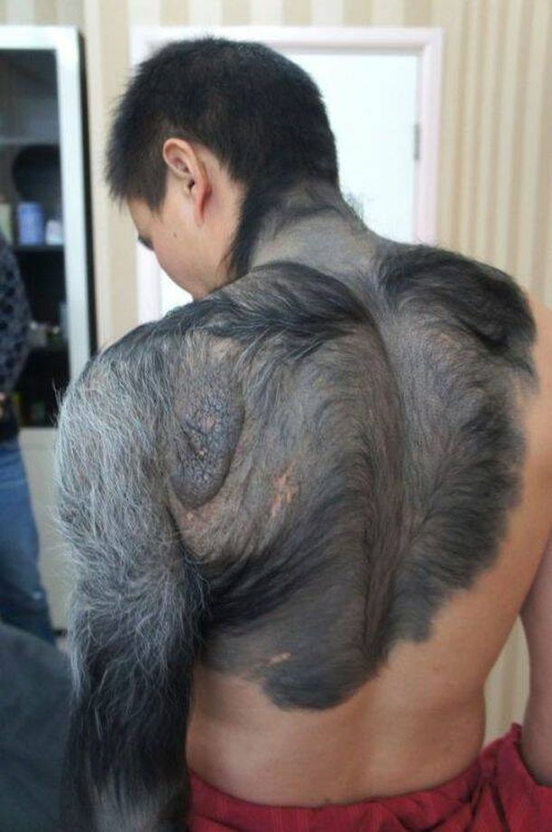 Por un defecto genético se convirtió en un hombre lobo