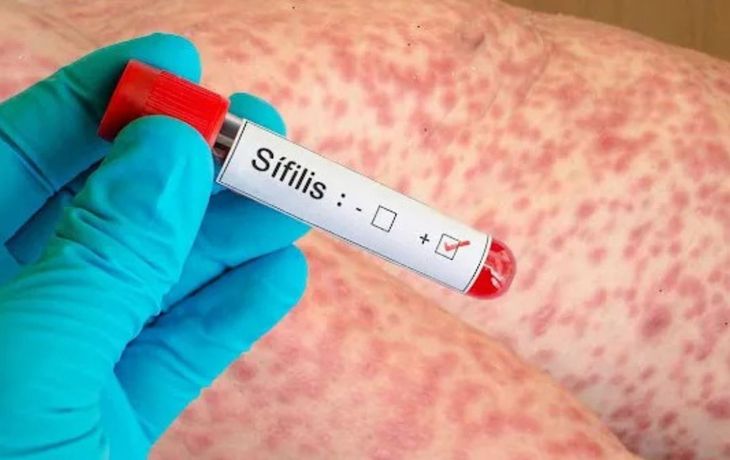 Alerta sanitaria: la sífilis superó los 55 mil casos en el último año en Argentina