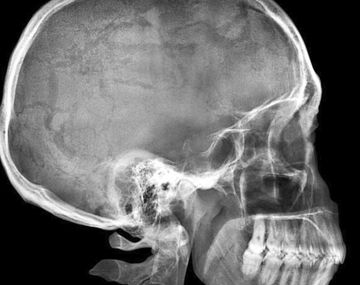 Fue al hospital por dolores de cabeza y le hallaron una bala en el cráneo