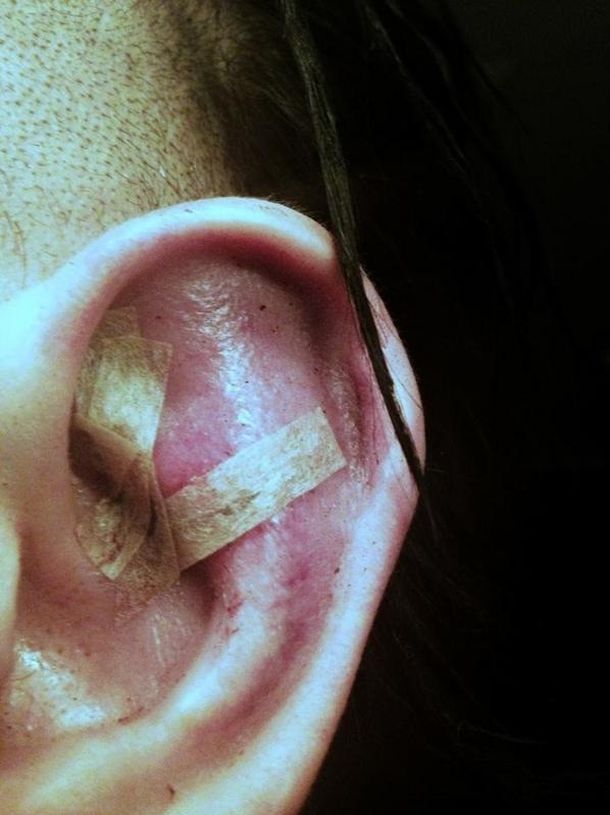 Así quedó la oreja de Marilyn Manson