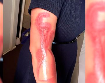 Una mujer asegura que el iPhone le generó quemaduras de segundo grado