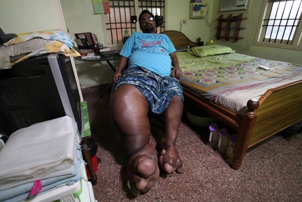 La historia del hombre con piernas de elefantes que pide ayuda para curarse