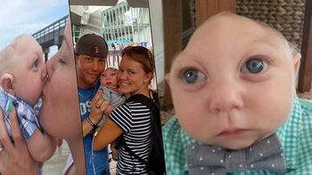 nacio sin la mitad de su craneo pero supero las expectativas y cumplio un ano nacio sin la mitad de su craneo pero supero las expectativas y cumplio un ano