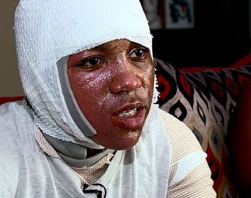 Por un desafío viral se tiró agua hirviendo y ahora tiene quemaduras de segundo grado