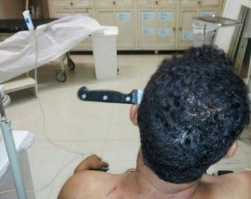 Médicos le retiran a un hombre un cuchillo que tenía clavado en la cabeza