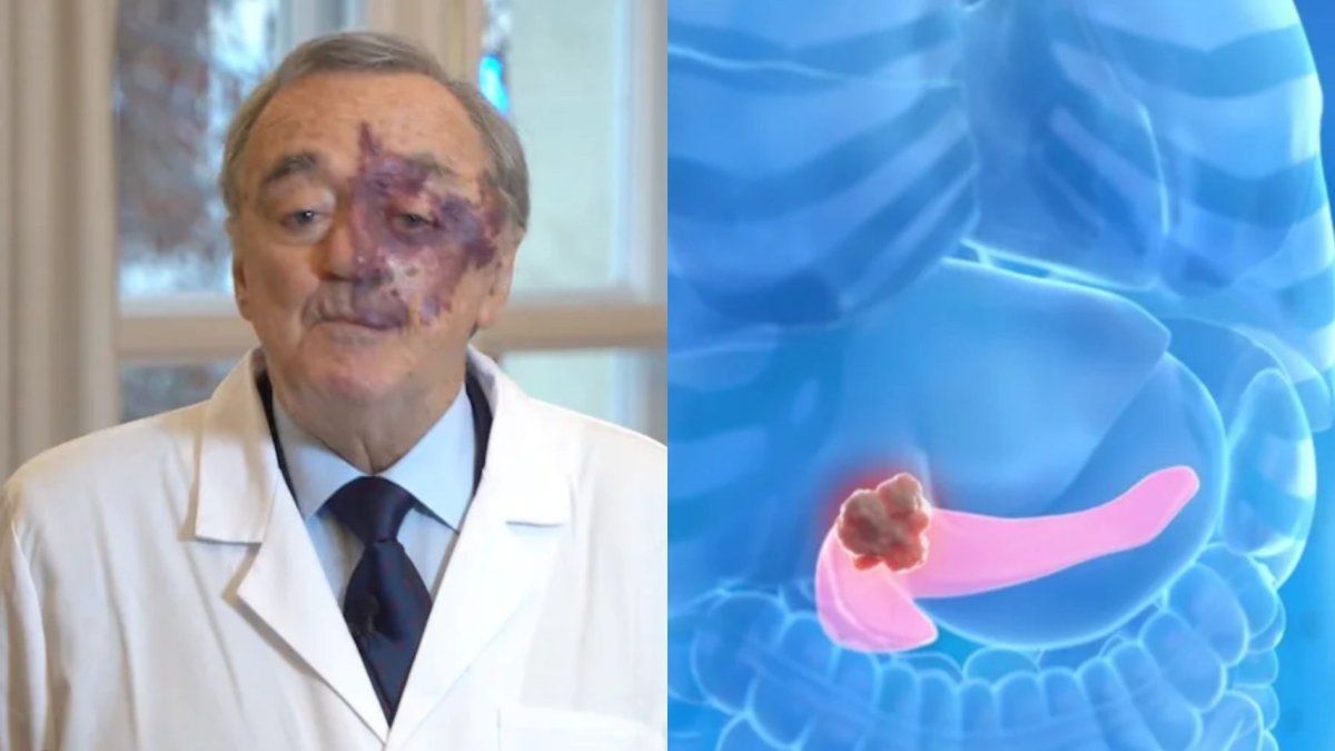 Gran hallazgo: una triple terapia abre una nueva esperanza frente al cáncer  de páncreas