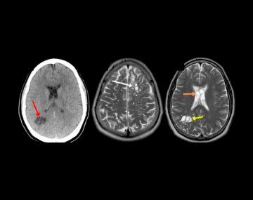 Le dolía la cabeza y el diagnostico fue devastador: Había un gusano