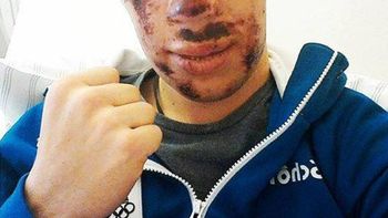 impresionante: asi quedo un esquiador tras esta escalofriante caida impresionante: asi quedo un esquiador tras esta escalofriante caida