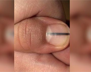 Fue a hacerse la manicura y le detectaron un melanoma
