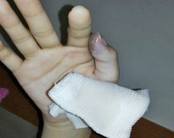 Fue a la guardia por un cuadro gripal y casi le tienen que amputar un dedo