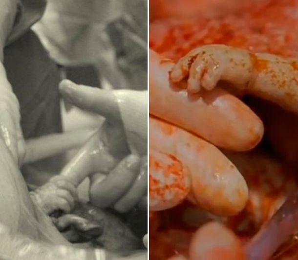 La beba que le agarró el dedo al médico igualó a la ficción