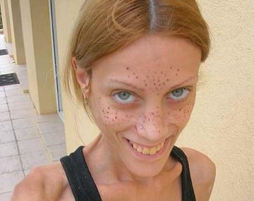 Chica anoréxica Isabelle Caro
