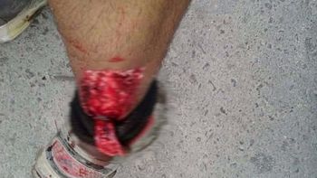 Un pitbull atacó a un recolector de basura en La Plata Un pitbull atacó a un recolector de basura en La Plata