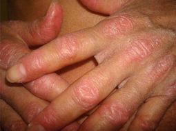 Lupus: la importancia de erradicar mitos