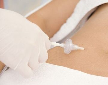 Tratamiento de carboxiterapia