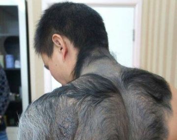 Por un defecto genético se convirtió en un hombre lobo