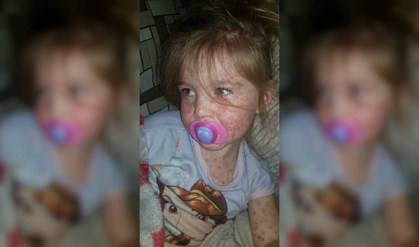 Le dijeron que su hija tenía varicela pero se había contagiado fiebre aftosa humana
