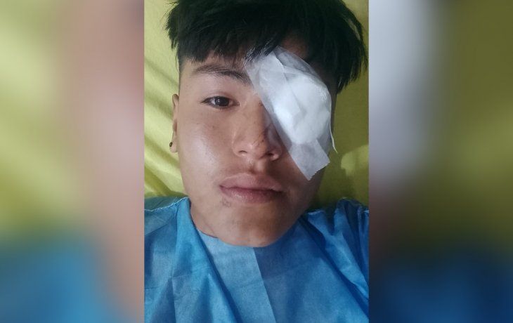 Represión en Jujuy: un joven perdió un ojo por las balas de goma