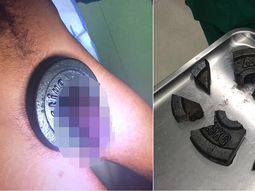 metio su pene en una pesa, se le atasco y tuvo que ser salvado por los bomberos metio su pene en una pesa, se le atasco y tuvo que ser salvado por los bomberos