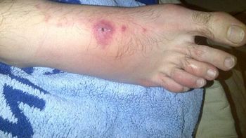 los pies de mayer siguen mostrando las secuelas de la batalla de la davis los pies de mayer siguen mostrando las secuelas de la batalla de la davis