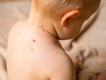 Sarampión: confirman otro caso en la Ciudad y hay preocupación