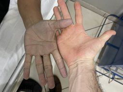 Médico recibe a paciente con manos azules y el diagnóstico sorprende a todos