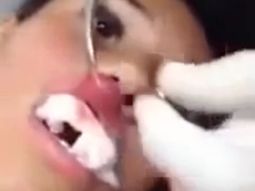 Insólito: sentía dolor en el labio y le sacaron un gusano