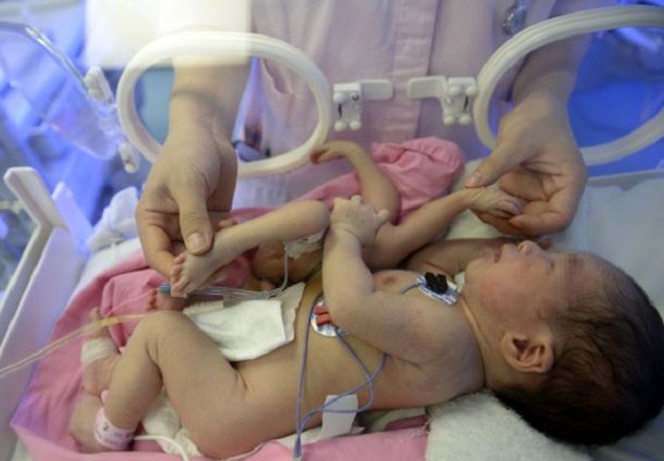 Nace en China un bebé con cuatro piernas y cuatro brazos