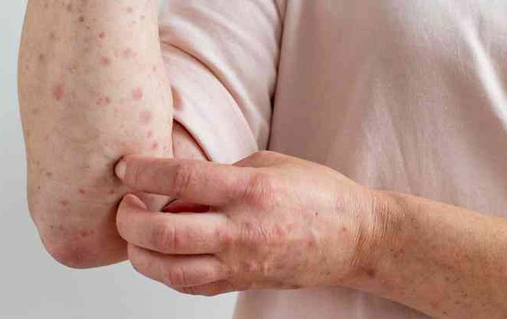 Confirman en San Isidro el primer caso autóctono de viruela del mono