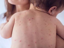 sarampion en caba: sintomas, contagio, prevencion sarampion en caba: sintomas, contagio, prevencion