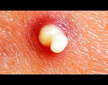 ¿Qué sucede si explotas tus granitos?, el viral del momento