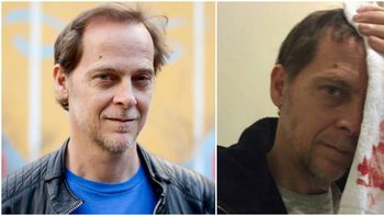 Matías Martin tuvo un accidente domético. Matías Martin tuvo un accidente domético.