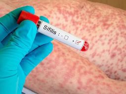 alerta sanitaria: la sifilis supero los 55 mil casos en el ultimo ano en argentina alerta sanitaria: la sifilis supero los 55 mil casos en el ultimo ano en argentina