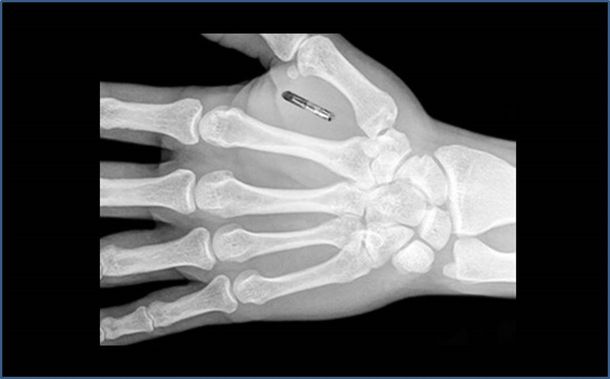Chips en el cuerpo, lo nuevo en tecnología